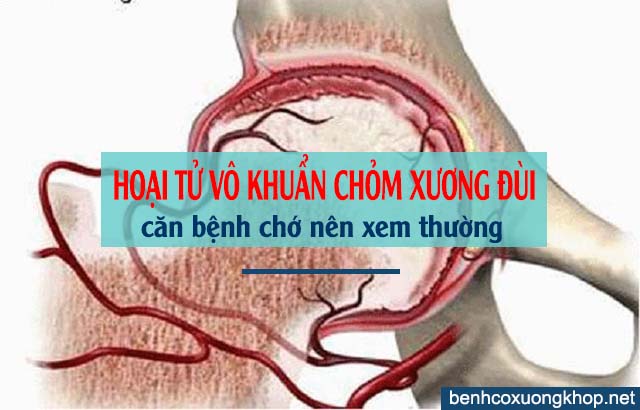 hoại tử vô khuẩn chỏm xương đùi