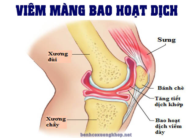 viêm màng bao hoạt dịch