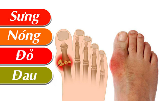 Dấu hiệu nhận biết bệnh gout