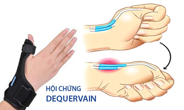  Hội chứng De Quervain gây đau khớp ngón tay