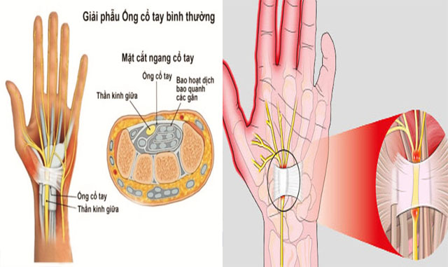 Hội chứng ống cổ tay gây đau khớp ngón tay
