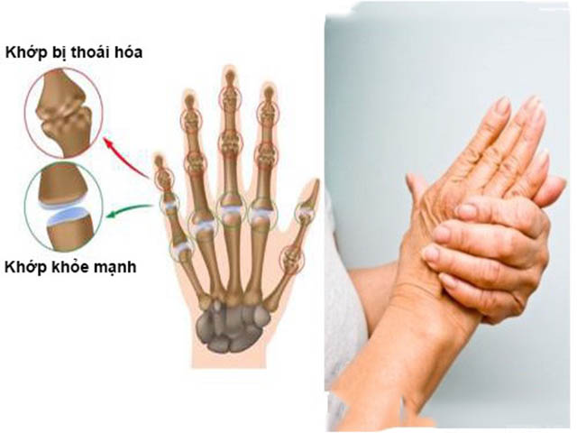 Bệnh thoái hóa khớp gây đau khớp ngón tay