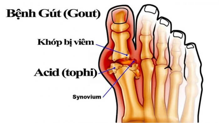 Khớp xương có tiếng kêu lục cục do bệnh gout gây ra