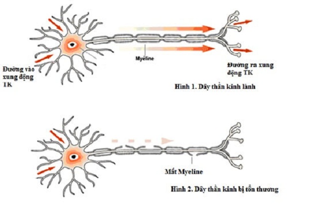 Bệnh viêm đa rễ dây thần kinh là gì?