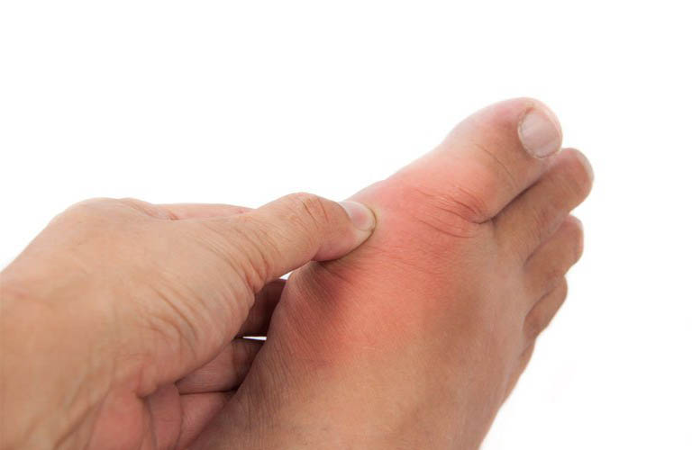 Gout là bệnh lý ngày càng phổ biến, xuất hiện ở nhiều đối tượng