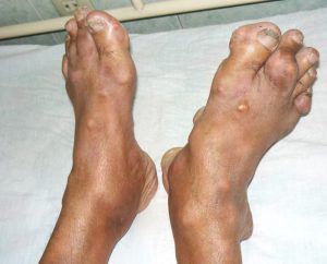 bệnh Gout là gì 