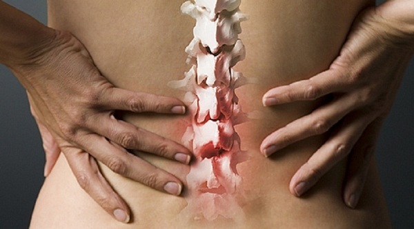 Thoái hóa cột sống thắt lưng gây đau lưng dữ dội khi bệnh nặng