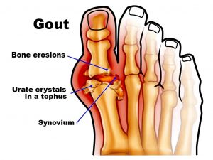 khám chữa bệnh gout