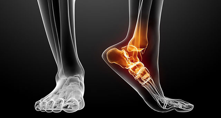 Trật khớp cổ chân là gì