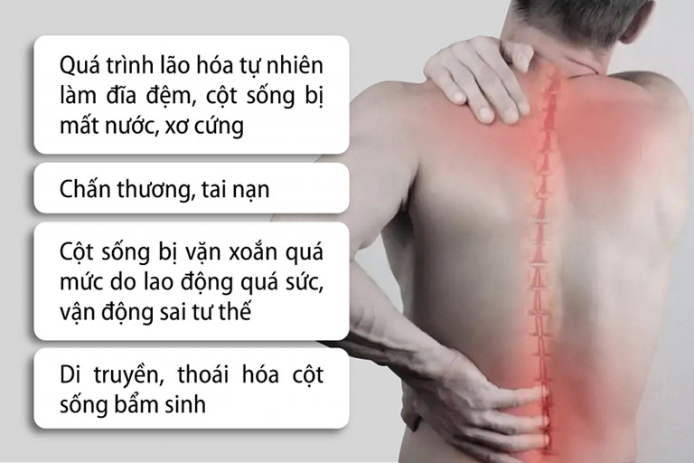 Nguyên nhân gây thoát vị đĩa đệm