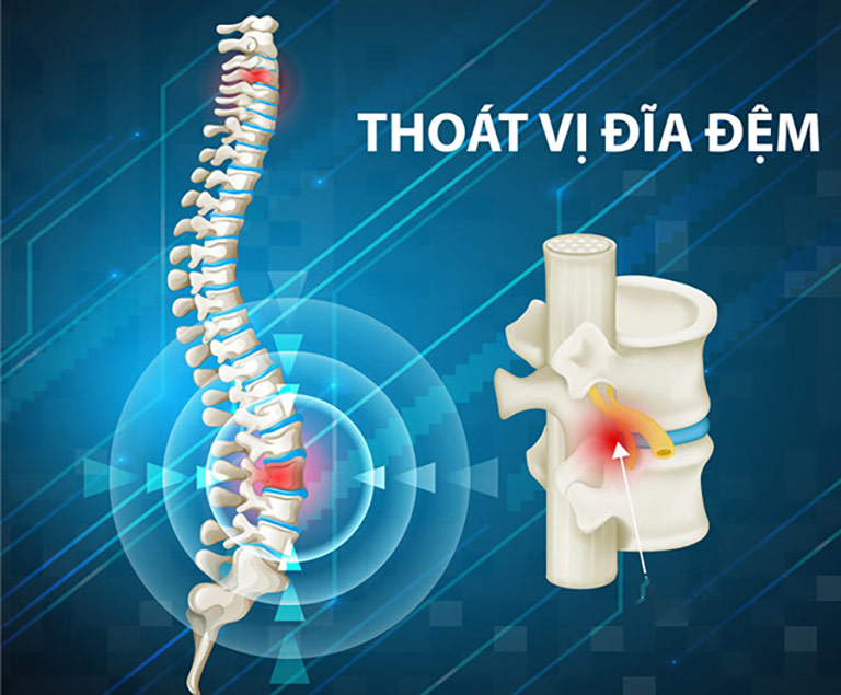 Đĩa đệm dễ bị tổn thương, nứt rách biến chứng nguy hiểm nếu không sớm phát hiện