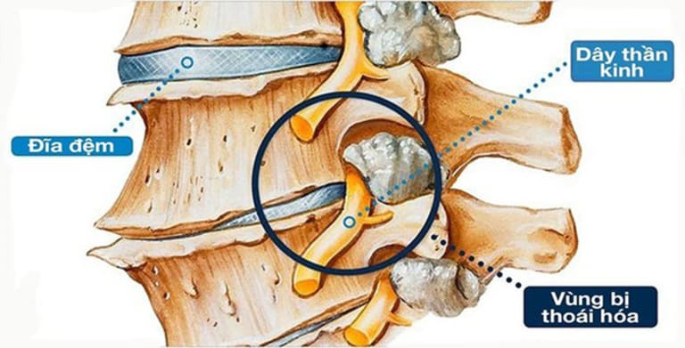 Thoái hóa cột sống có chữa được không là thắc mắc chung của nhiều người bệnh